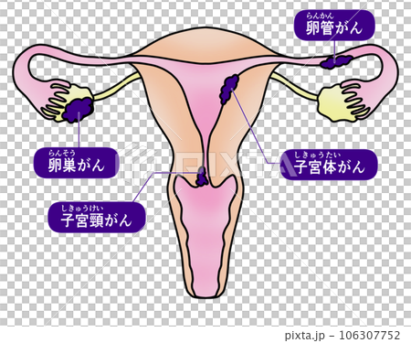 子宮頸がんと子宮体がんと卵巣がんと卵管がんのシンプルなイラスト 106307752