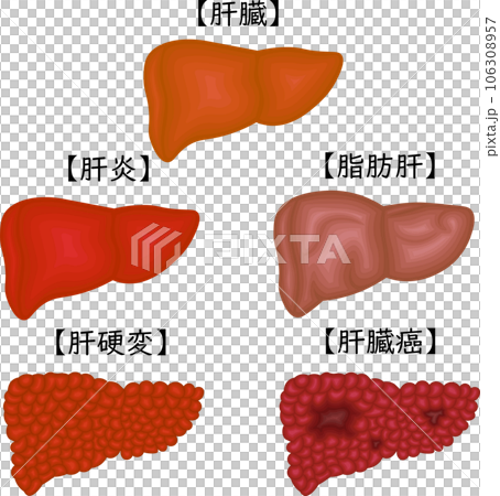 肝臓　病気　状態　イラスト　日本語 106308957