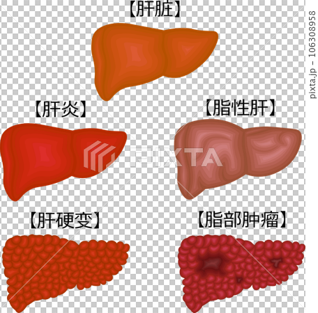 肝臟疾病狀況圖解中文 106308958