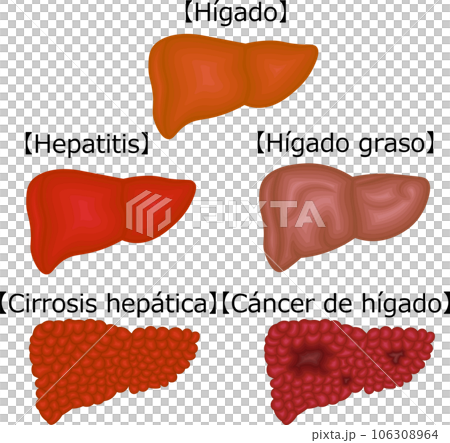 Liver disease condition illustration Spanish 106308964