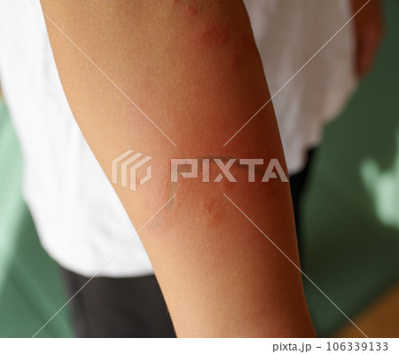 クラゲに刺された腕の傷跡 クラゲに刺された腕の傷跡 106339133