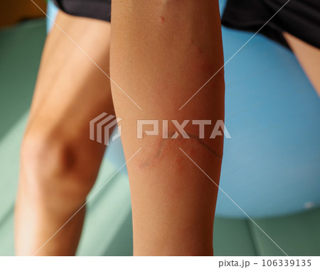 クラゲに刺された腕の傷跡 106339135