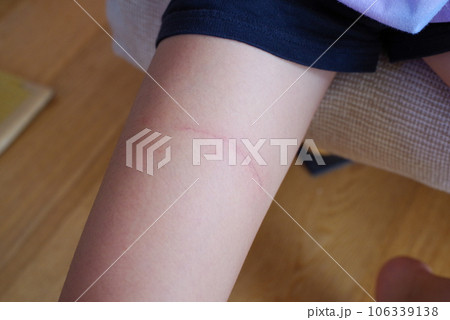 クラゲに刺された腕の傷跡 クラゲに刺された腕の傷跡 106339138