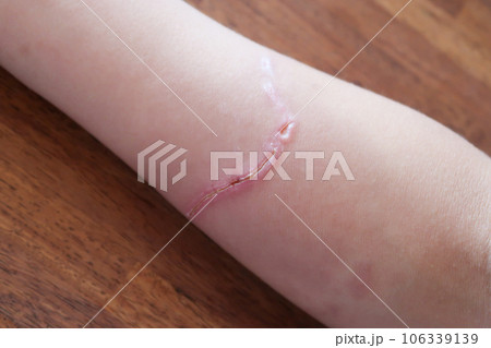 クラゲに刺された腕の傷跡 106339139
