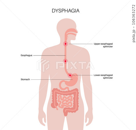 Dysphagia medical poster 106363272