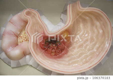 胃がん 模型 胃がん 模型 106370183