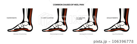 Heel pain diagram 106396778