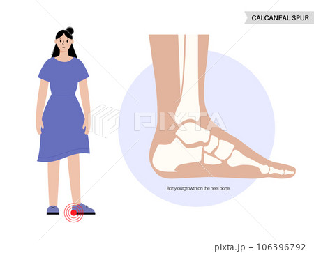 Heel spur poster Heel spur poster 106396792