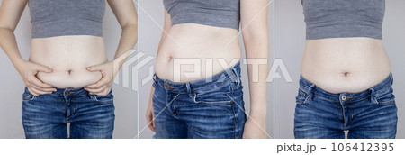 Obesity Cellulite. Folds of excess fat on woman waist. Before and after. Concept of losing weight, playing sports, checking result from diet and intense training. Result of losing weight. Liposuction Obesity Cellulite. Folds of excess fat on woman waist. Before and after. Concept of losing weight, playing sports, checking result from diet and intense training. Result of losing weight. Liposuction 106412395