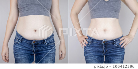 Obesity Cellulite. Folds of excess fat on woman waist. Before and after. Concept of losing weight, playing sports, checking result from diet and intense training. Result of losing weight. Liposuction 106412396