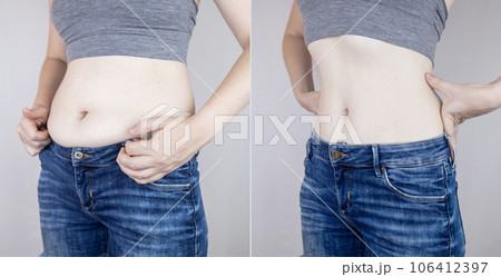 Obesity Cellulite. Folds of excess fat on woman waist. Before and after. Concept of losing weight, playing sports, checking result from diet and intense training. Result of losing weight. Liposuction Obesity Cellulite. Folds of excess fat on woman waist. Before and after. Concept of losing weight, playing sports, checking result from diet and intense training. Result of losing weight. Liposuction 106412397