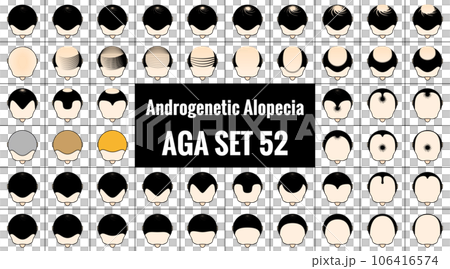 男性型脱毛症52種類。ハゲ頭のアイコン。AGA治療と薄毛の進行具合。ベクターイラスト。 106416574