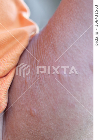 畑で虫に刺されました。 106431503