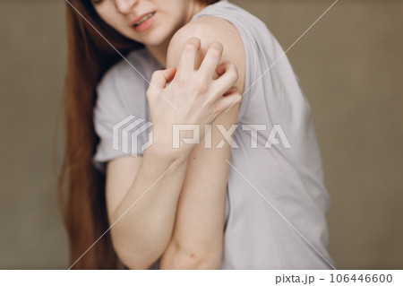 Allergy dermatology scabies itches hand skin problem woman 106446600