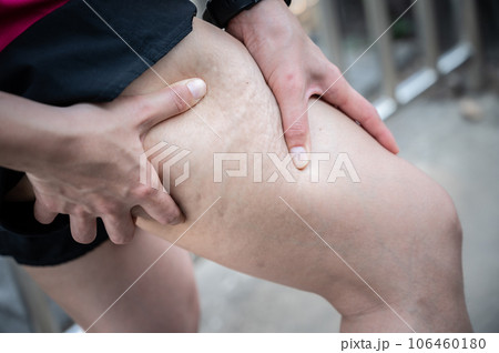 Woman with cellulite (known as orange-peel skin) problem appears on her legs. cellulite It forms when fatty tissue deep in the skin pushes up against connective tissue. 106460180