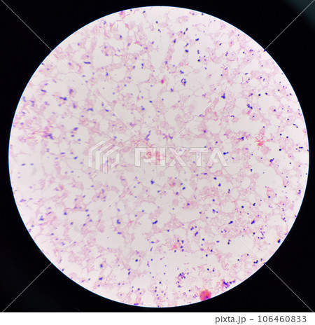 Red cell gram negative bacilli in hemo culture. 106460833