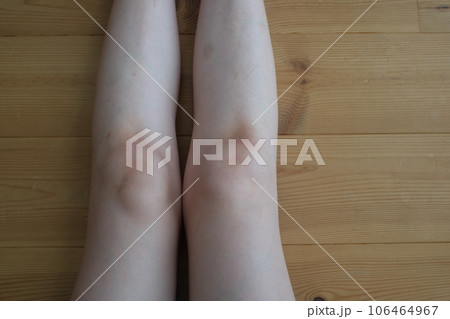 脚　膝の黒ずみ 106464967