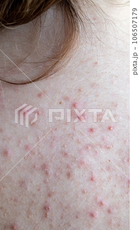 woman back with acne, red spots, skin disease woman back with acne, red spots, skin disease 106507179
