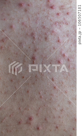 woman back with acne, red spots, skin disease woman back with acne, red spots, skin disease 106507181