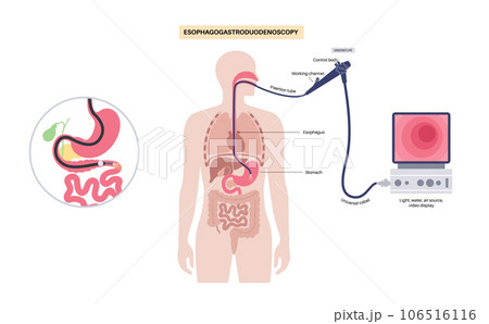 Esophagogastroduodenoscopy medical procedure Esophagogastroduodenoscopy medical procedure 106516116