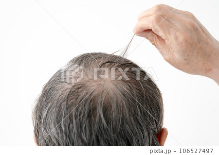薄毛 AGA 男性 薄毛 AGA 男性 106527497