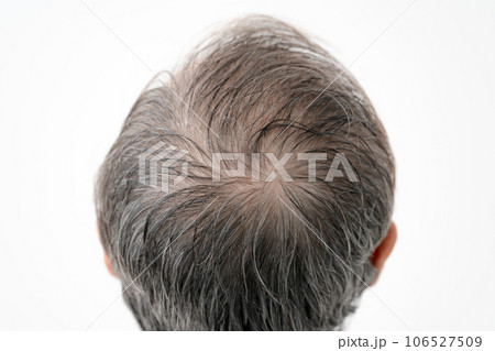 薄毛 AGA 男性 薄毛 AGA 男性 106527509