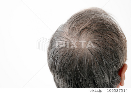 薄毛 AGA 男性 薄毛 AGA 男性 106527514
