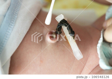 Treatment of the navel and umbilical cord of a newborn with hydrogen peroxide and a cotton swab to dry and heal the umbilical cord of an infant. Medical Treatment of the navel and umbilical cord of a newborn with hydrogen peroxide and a cotton swab to dry and heal the umbilical cord of an infant. Medical 106548126