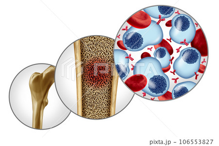 Multiple Myeloma 106553827