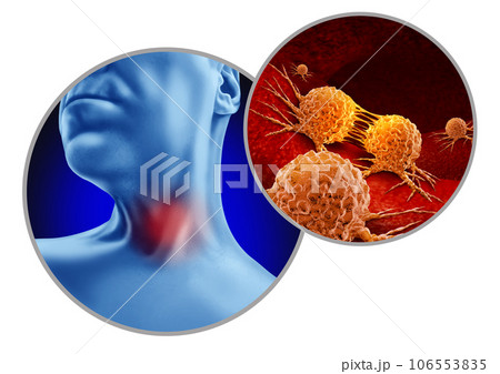 Throat Cancer 106553835