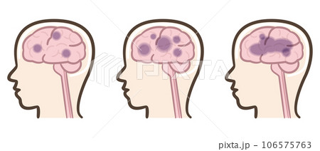 アルツハイマー型認知症 脳のイラスト アルツハイマー型認知症 脳のイラスト 106575763