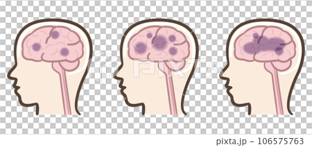 アルツハイマー型認知症 脳のイラスト アルツハイマー型認知症 脳のイラスト 106575763