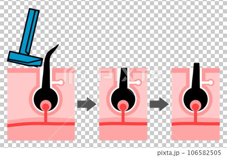 無駄毛をカミソリで剃った肌の断面イラスト 106582505
