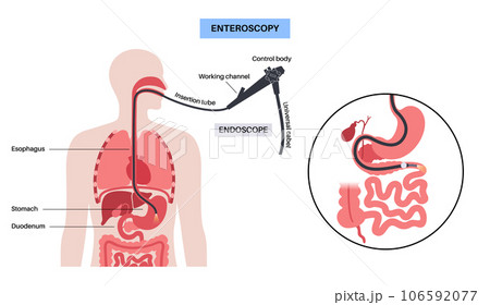 Esophagogastroduodenoscopy medical procedure 106592077