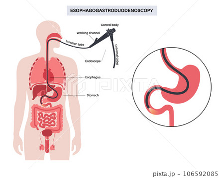 esophagogastroduodenoscopy medical procedure esophagogastroduodenoscopy medical procedure 106592085