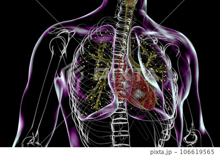 Lung adiaspiromycosis, 3D illustration 106619565