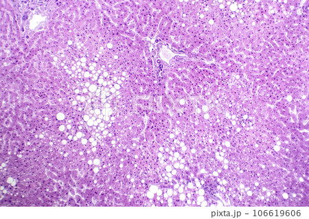 Hepatic steatosis, light micrograph 106619606