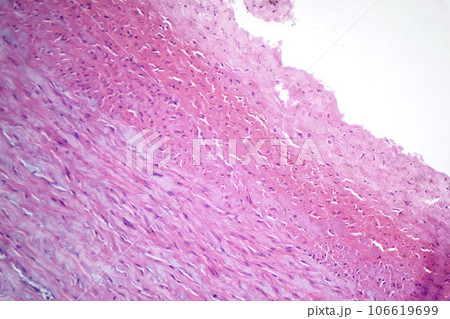 Fibrinoid necrosis in a vessel wall, light micrograph 106619699