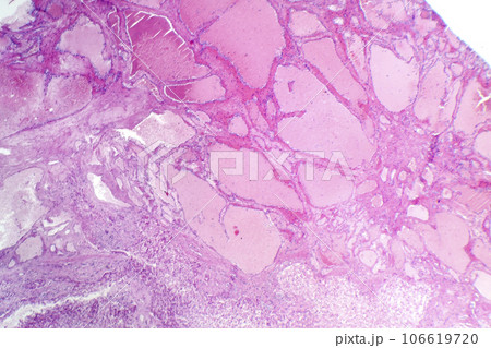 Hepatic cavernous hemangioma, light micrograph 106619720