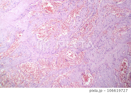 Capillary hemangioma, light micrograph 106619727