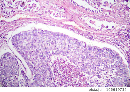 Lung adenocarcinoma, light micrograph 106619733