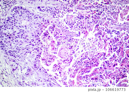 Squamous cell carcinoma of the lung, light micrograph 106619773