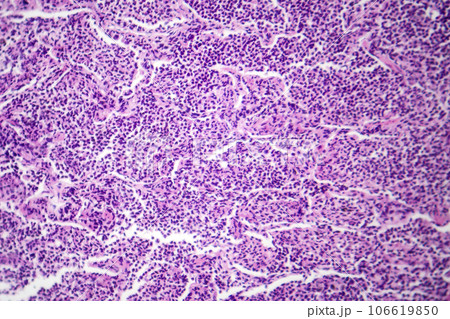 Interstitial pneumonia, light micrograph 106619850