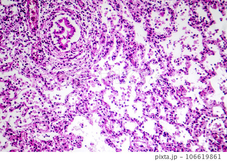 Photomicrograph of bronchopneumonia, lobular pneumonia 106619861