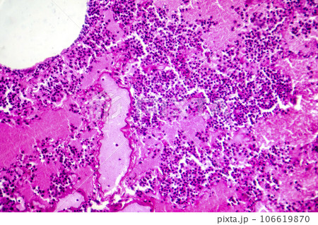 Lobar pneumonia during the hemorrhagic edema period, light micrograph Lobar pneumonia during the hemorrhagic edema period, light micrograph 106619870