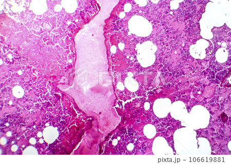 Lobar pneumonia during the hemorrhagic edema period, light micrograph 106619881