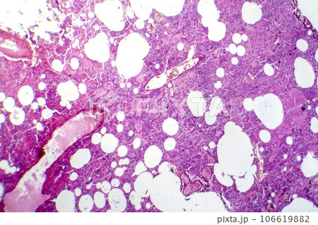 Lobar pneumonia during the hemorrhagic edema period, light micrograph 106619882
