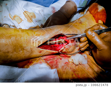 When leg fracture occurs, medical professionals resort to installing metal plate during surgery. When leg fracture occurs, medical professionals resort to installing metal plate during surgery. 106621478