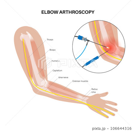 Elbow arthroscopy surgery 106644316