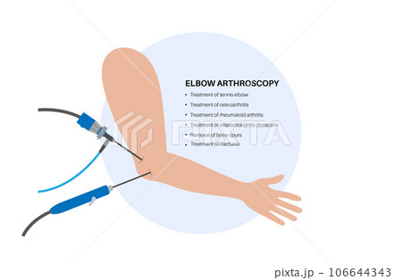 Elbow arthroscopy surgery 106644343